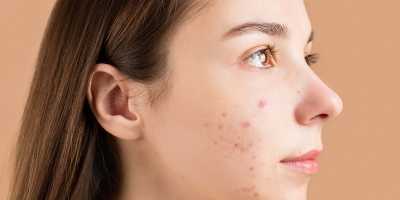 Rice water reduces acne